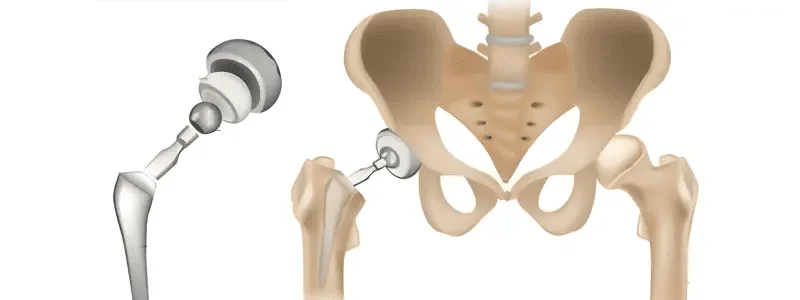 hip replacement surgery in Englewood, NJ