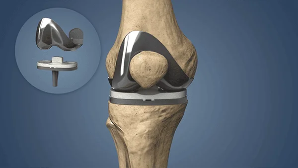 Knee Replacement New Jersy