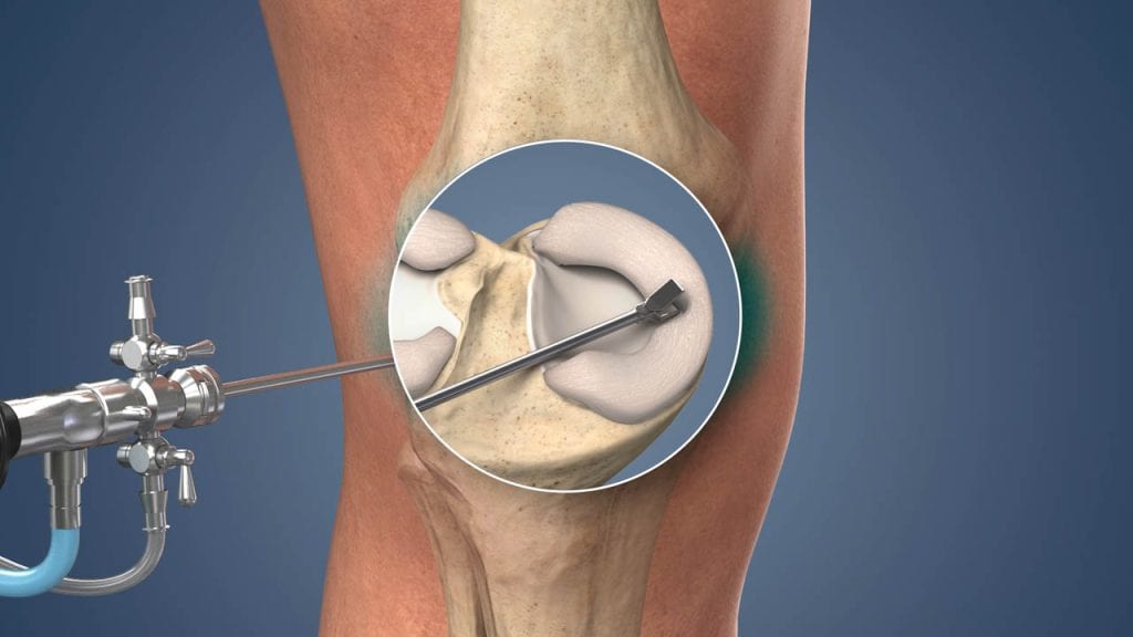 Illustration of a knee arthroscopy