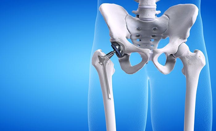 Illustration of a hip replacement implant