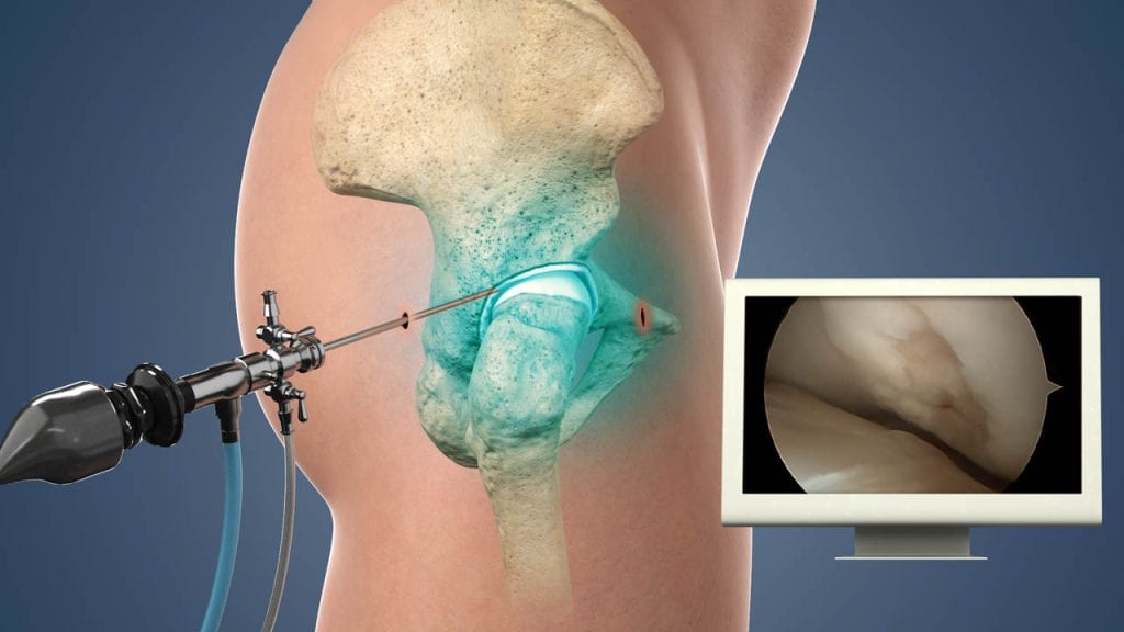Arthroscopy in Englewood, NJ