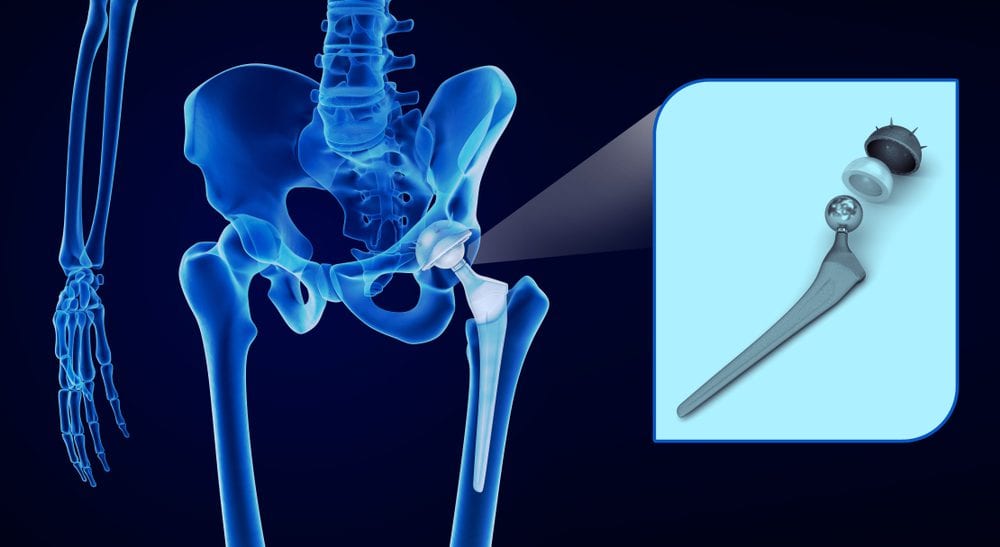 Partial Hip Replacement
