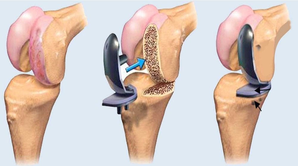 Knee replacement illustration from the practice website