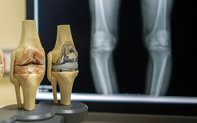 Knee joint models showing natural and replacement joint surfaces